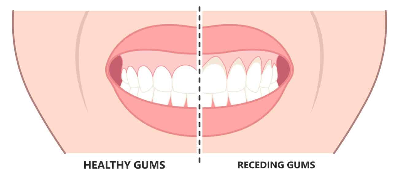 What Causes Gums to Recede Over Time High-Wycombe